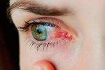 Loại thuốc nhỏ mắt bị nghi ngờ khiến một người tử vong, 8 trường hợp mù-3