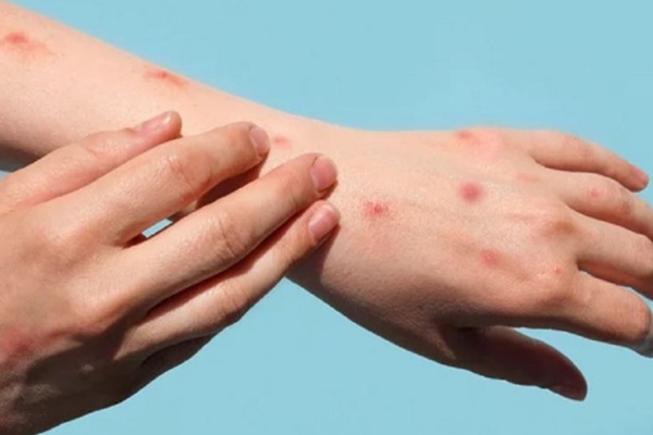 Nữ bệnh nhân đậu mùa khỉ thứ hai xuất viện-1