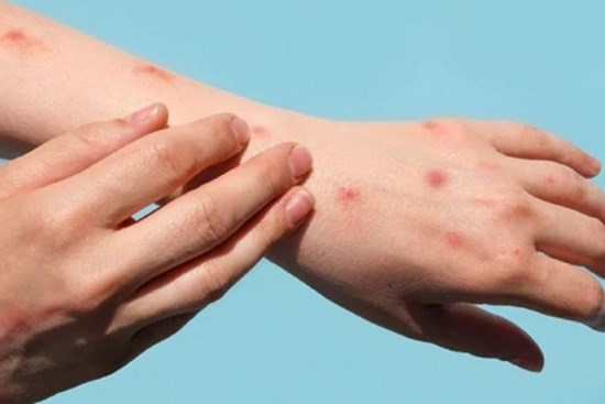 Phát hiện ca thứ hai mắc đậu mùa khỉ về từ Dubai