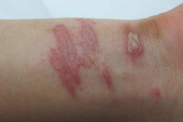 Cách xử trí khi bị kiến ba khoang đốt-3