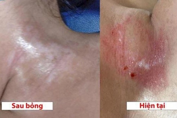 Bé gái 19 tháng tuổi bỏng nặng vì lọ dung dịch hầu hết nhà nào cũng có-2