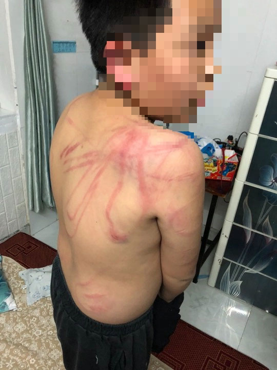 Lãnh đạo TP Đà Lạt thăm hỏi cháu trai 10 tuổi bị cha bạo hành dã man-1