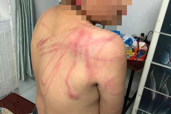 Lãnh đạo TP Đà Lạt thăm hỏi cháu trai 10 tuổi bị cha bạo hành dã man
