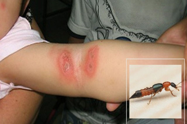 Tăng mạnh số ca nhập viện do sai lầm trong điều trị kiến ba khoang đốt, điều đầu tiên rất nhiều người mắc phải-1