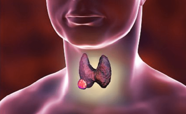 4 loại đồ ăn, thức uống nuôi lớn khối u tuyến giáp nhưng nhiều người thích-1