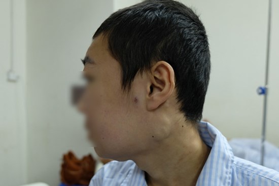 Sưng đau chân, acid uric tăng tưởng do gút, hoá ra mắc ung thư máu