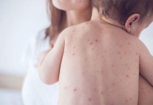 Dịch sốt xuất huyết lớn có nguy cơ xảy ra vào cuối năm 2022: Cảnh báo những đối tượng mắc sốt xuất huyết dễ bị trở nặng-3