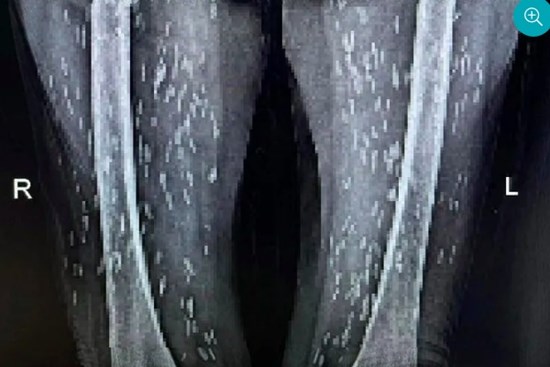 Nghiện món vạn người mê, cụ bà bị kén sán ken đặc khắp cơ thể