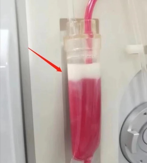 Máu của cô gái chuyển sang màu hồng, suy đa tạng nguy kịch chỉ vì 2 thói quen sinh hoạt phổ biến ở người trẻ-3