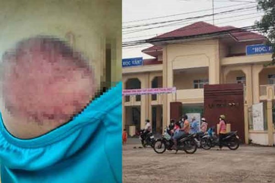 Học sinh tiểu học bị giáo viên đánh bầm tím mông vì nghịch, quên mang sách