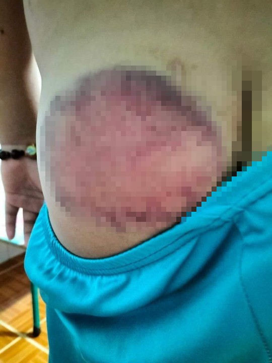 Học sinh tiểu học bị giáo viên đánh bầm tím mông vì nghịch, quên mang sách-1