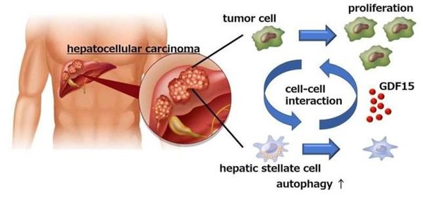 Tìm ra phương thức mới để ngăn ngừa ung thư gan-1