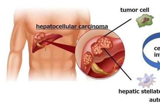 Tìm ra phương thức mới để ngăn ngừa ung thư gan