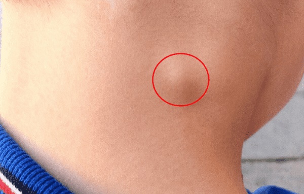 Triệu chứng cảnh báo căn bệnh ung thư hạch bạch huyết khiến nữ diễn viên Tây Thi bí sử” qua đời-3