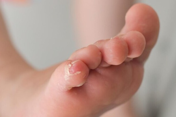 Trẻ mới 2 tháng tuổi bị hủy xương, viêm màng não vì lây giang mai từ mẹ-1