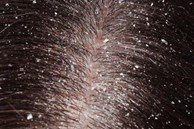 5 cách trị gàu đơn giản bằng nguyên liệu tự nhiên, kết hợp với dưỡng tóc mượt mà trong mùa thu đông