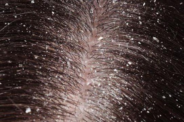 5 cách trị gàu đơn giản bằng nguyên liệu tự nhiên, kết hợp với dưỡng tóc mượt mà trong mùa thu đông-1