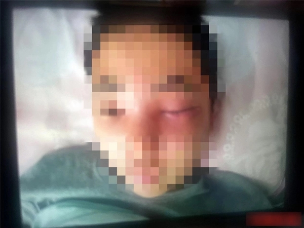 Nặn mụn ở mũi, thiếu niên bị viêm màng não do nhiễm trùng-1