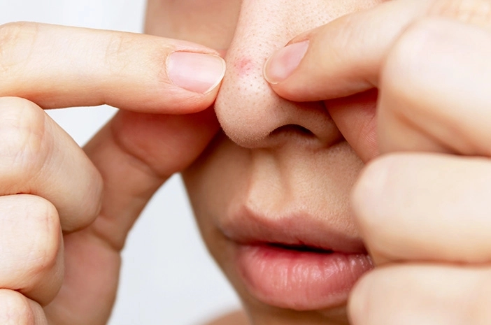 Nặn mụn ở mũi, thiếu niên bị viêm màng não do nhiễm trùng-4