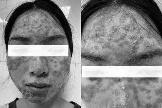 Bôi kem 'detox' trị trứng cá ở spa, cô gái trẻ ôm mặt đau rát đến viện cấp cứu