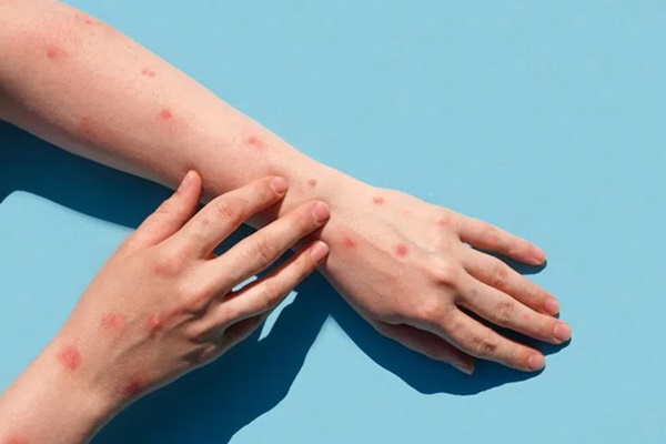 Bộ Y tế xếp đậu mùa khỉ vào bệnh truyền nhiễm nhóm B-2