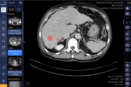 VinBrain hợp tác BV Đại học Y Dược TP.HCM ứng dụng AI chẩn đoán ung thư gan