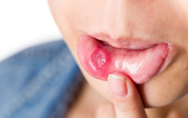 Nhiệt miệng mãi không khỏi, cô gái 27 tuổi đi khám phát hiện ung thư miệng phải cắt bỏ một nửa lưỡi-1