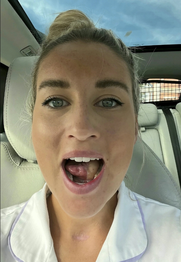 Nhiệt miệng mãi không khỏi, cô gái 27 tuổi đi khám phát hiện ung thư miệng phải cắt bỏ một nửa lưỡi-2