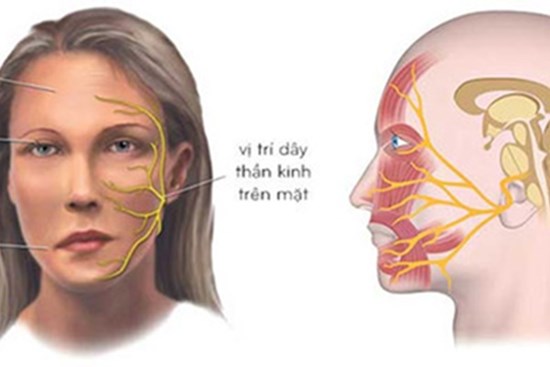 Người phụ nữ méo miệng, mất cảm giác nửa mặt sau một giấc ngủ