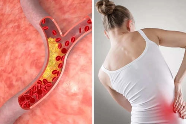 Dấu hiệu đầu tiên cảnh báo tình trạng cholesterol cao có thể làm tắc nghẽn động mạch của bạn-1