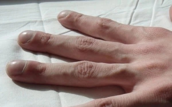 3 thay đổi ở ngón tay có thể báo hiệu nhiều bệnh ung thư-1