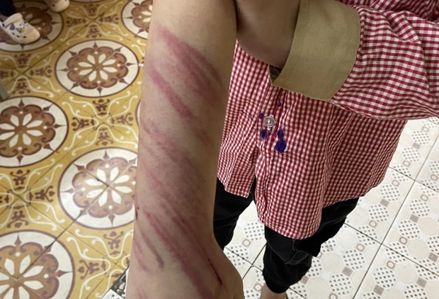 Hải Phòng: Học sinh lớp 2 nghi bị bạn trai của mẹ đánh đập, bầm tím khắp người-1