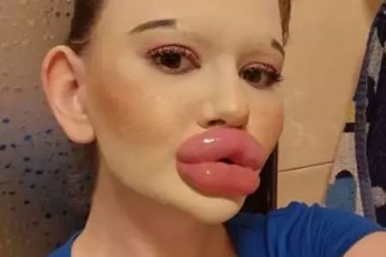 Cô gái 32 lần bơm môi muốn có cằm dài và nhọn nhất thế giới