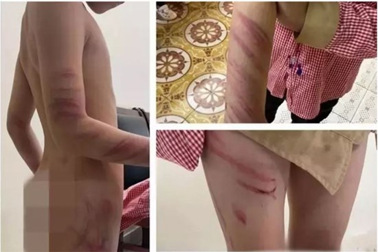 Bố dượng đánh bé trai 8 tuổi bầm dập: 'Dạy bảo chứ không ác ý'