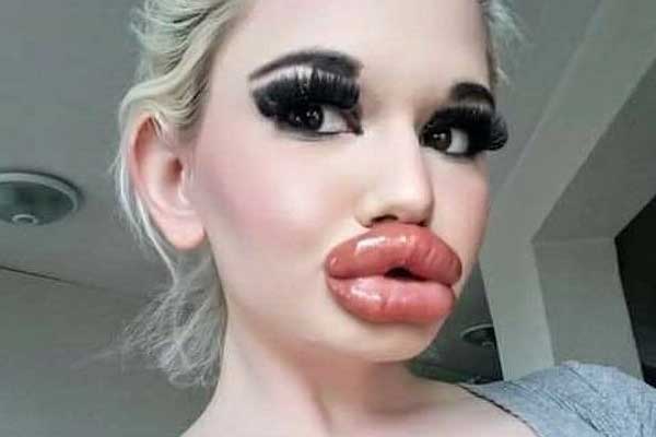 Dù nguy hiểm đến tính mạng, cô gái vẫn tiêm filler môi 32 lần-1