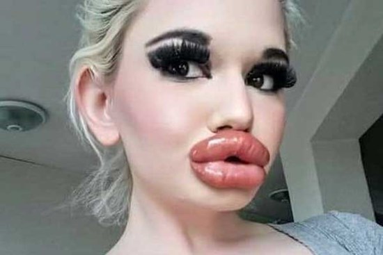 Dù nguy hiểm đến tính mạng, cô gái vẫn tiêm filler môi 32 lần