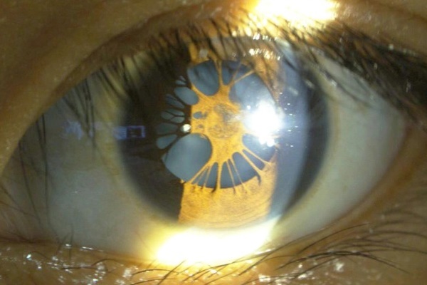 Cô gái trẻ bị mạng nhện giăng trong mắt-1