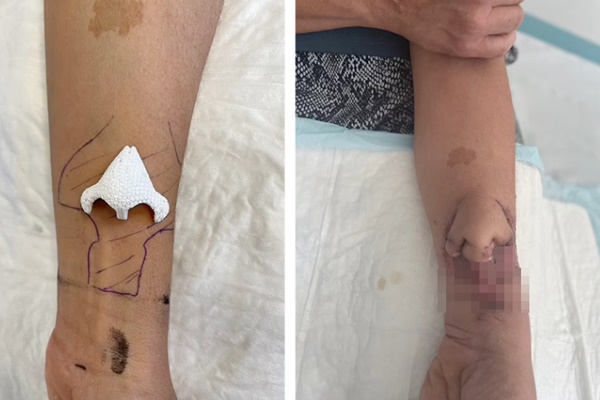 Người phụ nữ được ghép mũi nuôi trên cánh tay-1