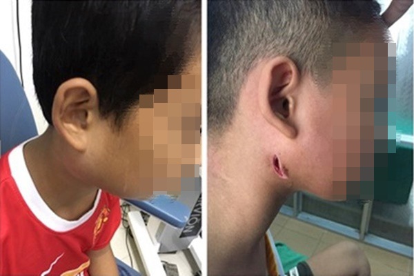 Những đối tượng có nhiều nguy cơ mắc bệnh Whitmore-2