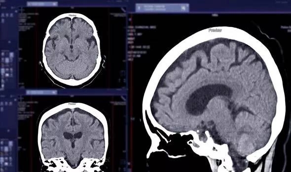 Dấu hiệu ở giọng nói cảnh báo sự sa sút trí tuệ, mất trí nhớ-2