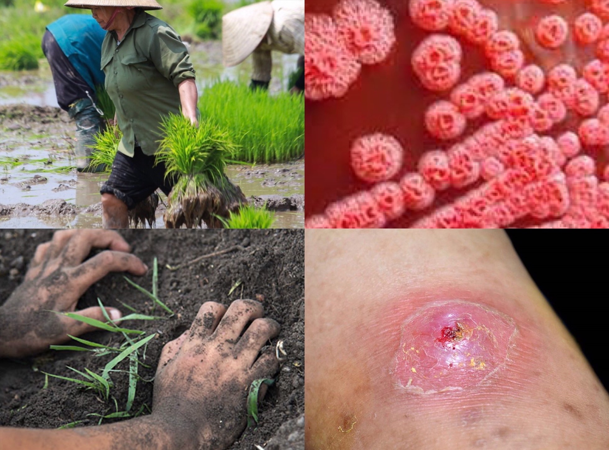 Những đối tượng có nhiều nguy cơ mắc bệnh Whitmore-1