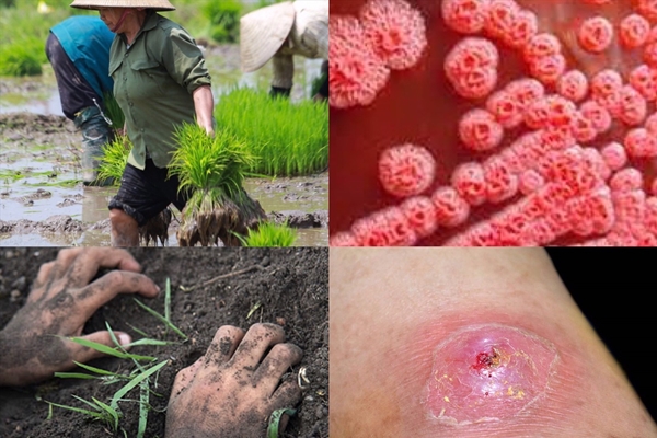 Mắc bệnh Whitmore, người đàn ông sốt cao suốt một tháng-2