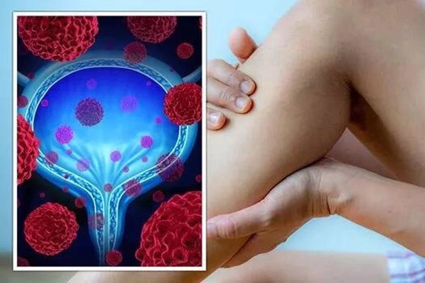 Gặp những biểu hiện này khi đi tiểu, coi chừng bệnh ung thư bàng quang đang tìm đến bạn-2