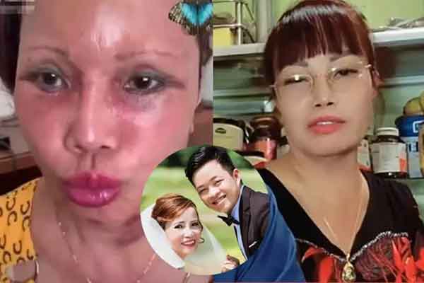 Nhan sắc cô dâu Cao Bằng sau 3 năm dao kéo biến chứng-9