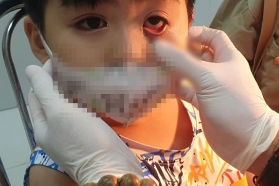 Trẻ sưng bụp mắt, nhắm nghiền vì sợ ánh sáng, cẩn thận bệnh do virus Adeno