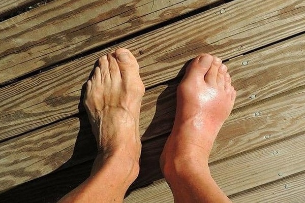 Những dấu hiệu khác thường trên bàn chân cho thấy sức khỏe của bạn đang ‘kêu cứu’-2