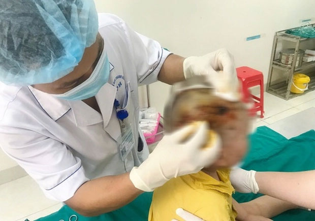 Bé 3 tuổi bị chó hàng xóm cắn trọng thương vùng đầu, mặt-1