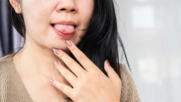 Người phụ nữ 39 tuổi phải cắt bỏ lưỡi sau khi bị ung thư giai đoạn 3, bác sĩ cảnh báo dấu hiệu phát hiện bệnh mà nhiều người bỏ qua-2