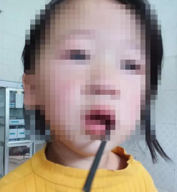 Bé gái 4 tuổi bị thanh sắt dài 20 cm đâm xuyên, mắc kẹt trong khoang miệng-1