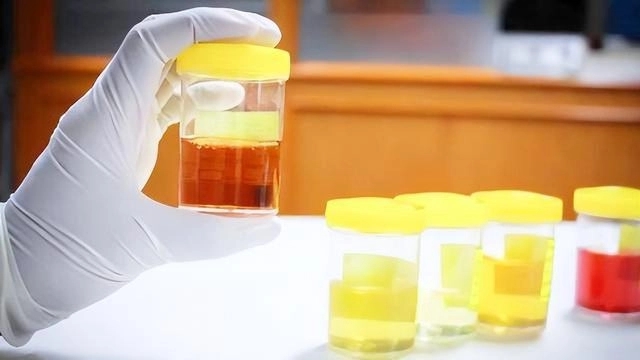 Nam hay nữ khi thấy 3 dấu hiệu này trong nước tiểu đều cần khám suy thận ngay-2